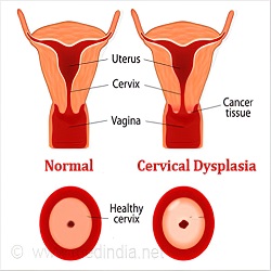 Dysplasie cervicale