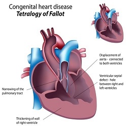 Malformations cardiaques congénitales