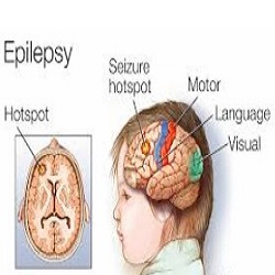 Épilepsie et convulsions