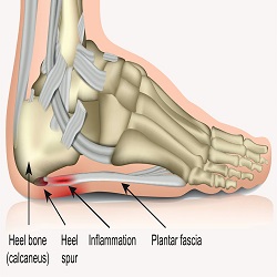 Douleurs et problèmes de pieds