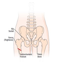 Fracture de la hanche