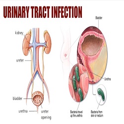 Infections des voies urinaires