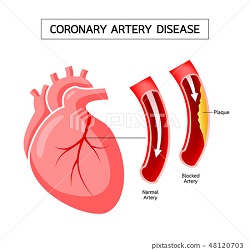 maladie de l'artère coronaire