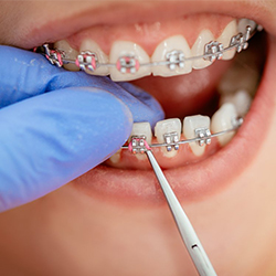 Un traitement orthodontique
